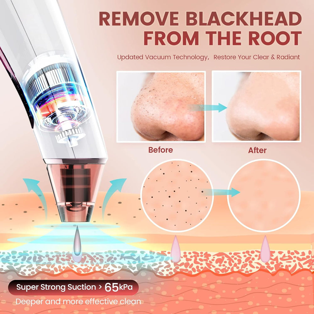 Blackhead Remover Vacuum